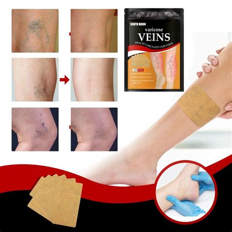 descărcați instrucțiuni pentru bandajarea picioarelor cu vene varicoase